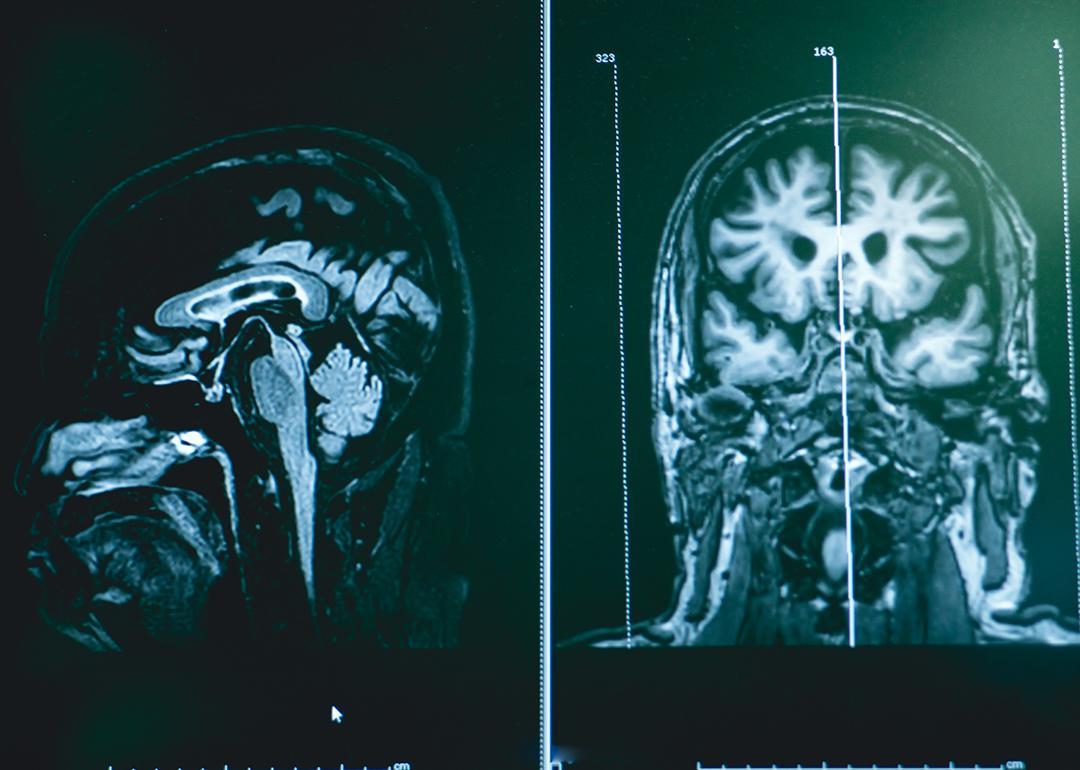 The early signs of frontotemporal dementia