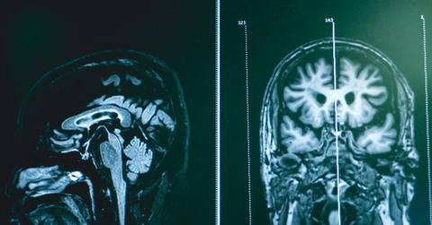 The early signs of frontotemporal dementia