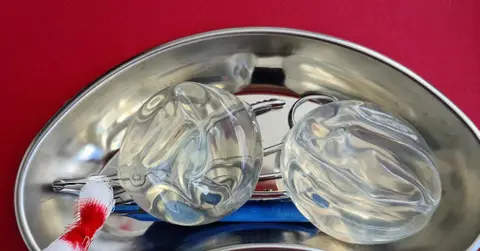 Deflationary trend: More Americans are removing their breast implants